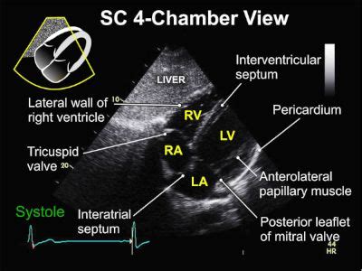 Subcostal Views (2 of 4) Tricuspid Valve, Mitral Valve, Video Image, Ultrasound, Leaflet, Echo ...