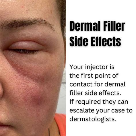 Dermal Fillers, Side Effects - Dr Davin Lim