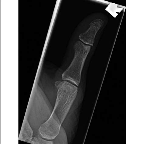 Preoperative X-ray of the right thumb (lateral). | Download Scientific ...