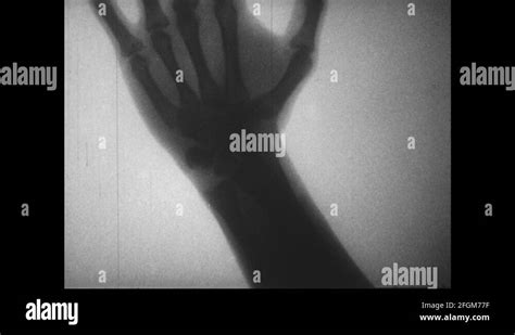 X ray of the forearm bones Stock Videos & Footage - HD and 4K Video Clips - Alamy