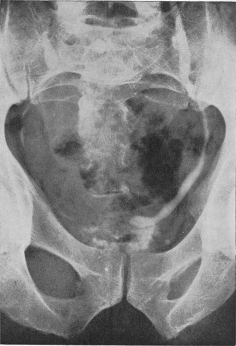 Ureterocele as a Cause of Abdominal Pain | NEJM