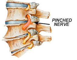 Can Massage Help a Pinched Nerve? — Adica Massage Clinic