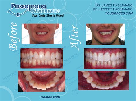 Minor Crowding with Invisalign in 12 Months! - Passamano Orthodontics Irvine, CA Orthodontists