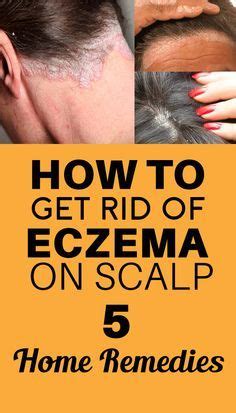 How to Get Rid of Eczema on Scalp – Home Remedies | Get rid of eczema ...