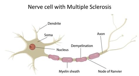 Multiple Sclerosis Treatment: Ketones are Better