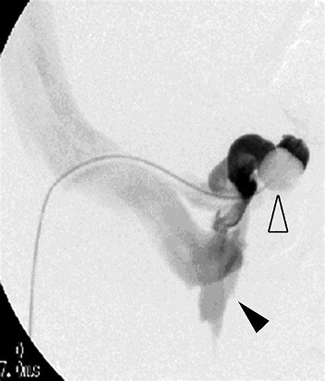 Hepatic Encephalopathy from Dual Splenorenal Shunts Treated with ...