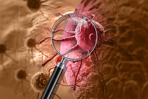 Oral Cancer: HPV-related Small Cell Carcinoma of the Oropharynx - Today's RDH