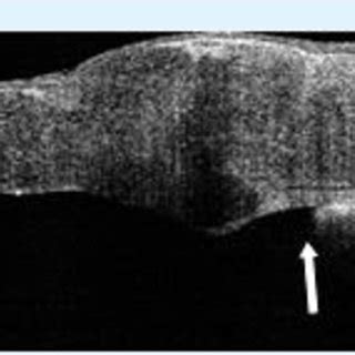 A: ASOCT arrow showing peripheral anterior synechiae near graft host... | Download Scientific ...