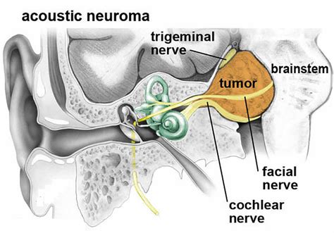 Acoustic Neuroma - Causes, Symptoms, Diagnosis, Treatment