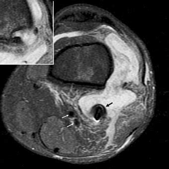 MRI at 6 months after the ACL reconstruction showed a 79 Â 60 Â 17 mm ...