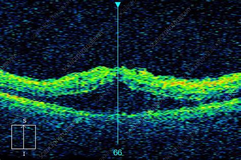 Diabetic macular oedema, OCT scan - Stock Image - C057/0656 - Science Photo Library