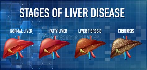 Stages of Liver Damage from Healthy, Fatty Liver, Fibrosis, Cirrhosis To Liver Cancer. Medical ...