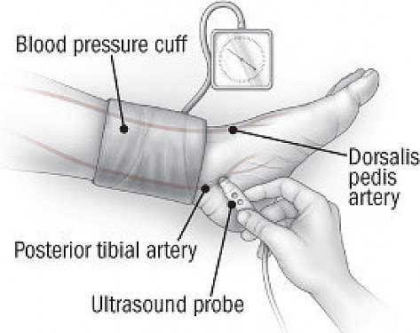 Tibial Brachial Index