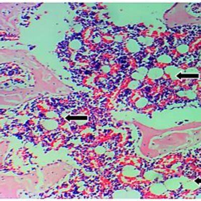 5. Photomicrograph of bone marrow of femur bone of T2 group rats... | Download Scientific Diagram