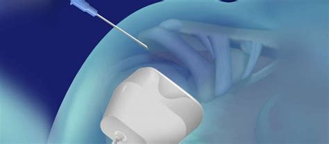 Ultrasound-Guided Injections – Dr. Scott Powell