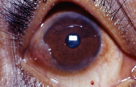 Limbal vernal keratoconjunctivitis | Limbal papillae in this… | Flickr