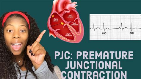 Basic EKG: Identifying premature junctional contractions- PJCS - YouTube