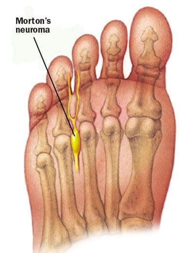 Morton's Neuroma Explanation, Symptoms, & Treatment - San Diego