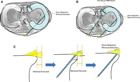 Meniscus Root Tear - Sun Orthopaedic