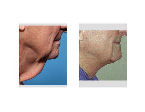 The Direct Neck Lift Scar - What Does It Look Like? - Explore Plastic Surgery