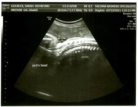 The Golbecks: 36 weeks . Last Ultrasound for growth