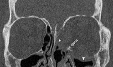 Coronal CT scan on a patient that underwent a medial and inferior wall... | Download Scientific ...