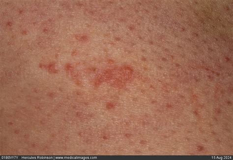 STOCK IMAGE, early stages of a herpes zoster shingles rash on a 72 year ...