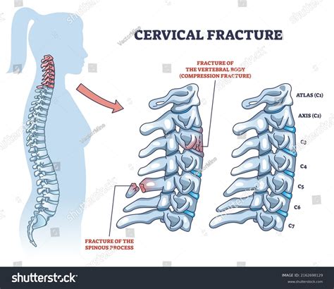 15 Fractured Spinous Process Cervical Vertebrae Images, Stock Photos & Vectors | Shutterstock