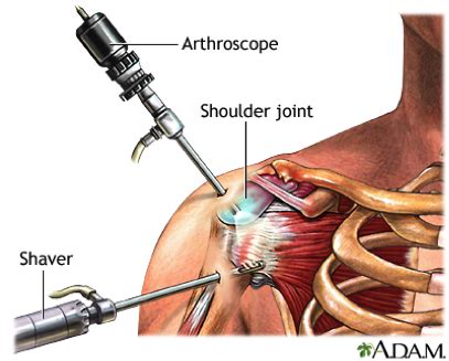 Shoulder Arthroscopy | Cal Sports & Orthopaedic Institute | Orthopaedic Specialists in Berkeley ...