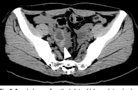 Figure 2 from Ruptured Corpus Luteal Cyst: Prediction of Clinical ...