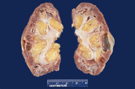 Renal Pathology