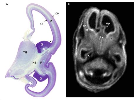 | Semi-horizontal Nissl-stained slide (A) and T1-weighted MRI slice (B)... | Download Scientific ...