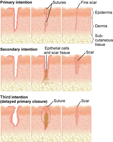 Wound healing by primary, secondary, and third intention | Wound care nursing, Fundamentals of ...