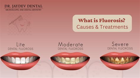 What is Fluorosis? Causes & Treatments