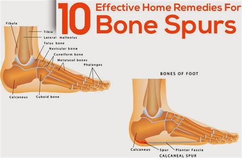 10 Effective Home Remedies For Bone Spurs ~ Mzizi Mkavu