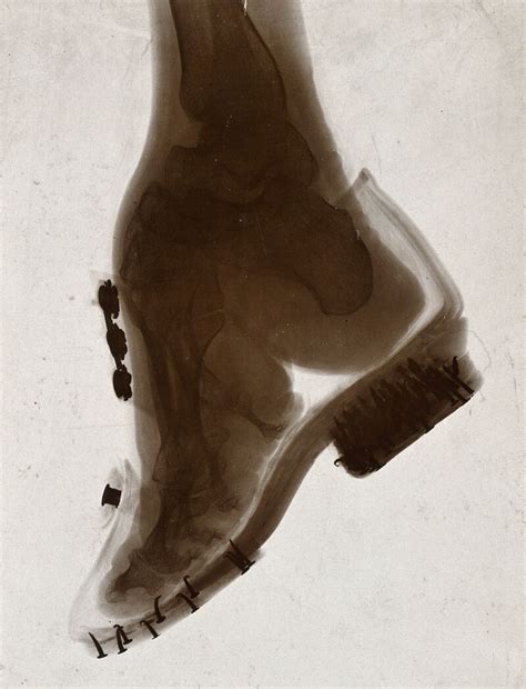 Foot of a Chinese woman, showing the effect of foot-binding. Photograph by (?) E.P. Minett, 192 ...