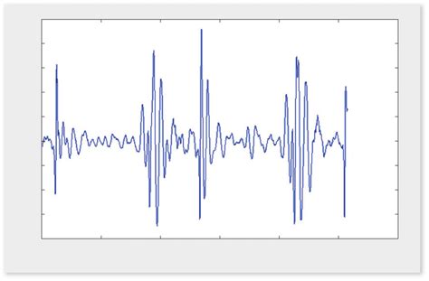 Typical phonocardiogram, a time recording of heart sounds. | Download ...