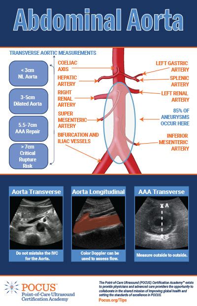 POCUS Tips | POCUS.org | Abdominal Aortic Aneurysm (AAA)