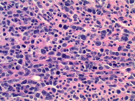 Follicular Lymphoma Pathology Outlines