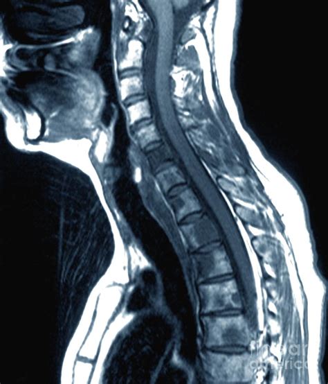 Secondary Bone Cancer In The Spine Photograph by Zephyr/science Photo ...