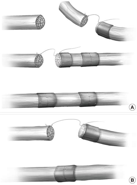 Illustration of the vein wrapping technique (A) Free ansa cervicalis ...