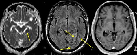 Angiographic Appearance of Encephalitis | neuroangio.org