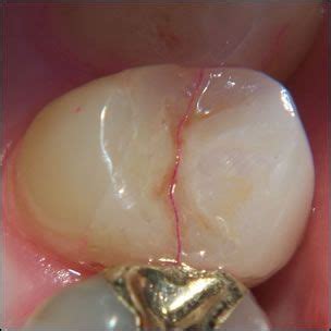 What is VRF (vertical root fracture) and cracked tooth syndrome? | News | Dentagama