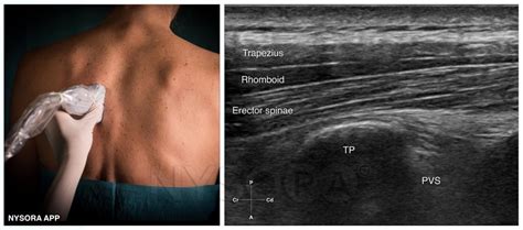 Erector Spinae Plane Nerve Block - NYSORA