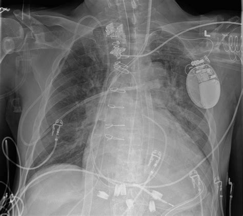 Surgical Steps In CentriMag Biventricular Assist Device (BiVAD ...