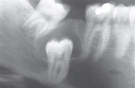 Dentigerous Cyst – INBDE Oral Pathology Mnemonics - Rememberology