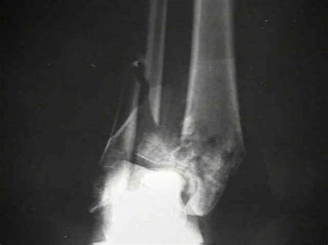 Plafond Vs Pilon Fracture