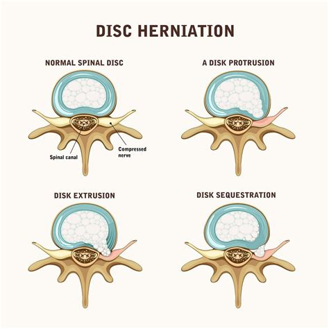 What Is The Difference Between A Disc Bulge And A Herniation Neuro | My ...