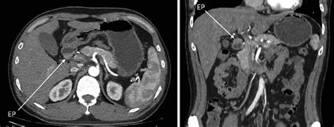 A contrast-enhanced CT findings. a Axial view showing moderate ...