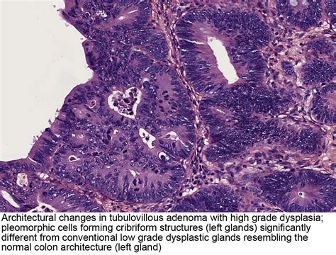 Pathology Outlines - Tubulovillous / villous adenoma